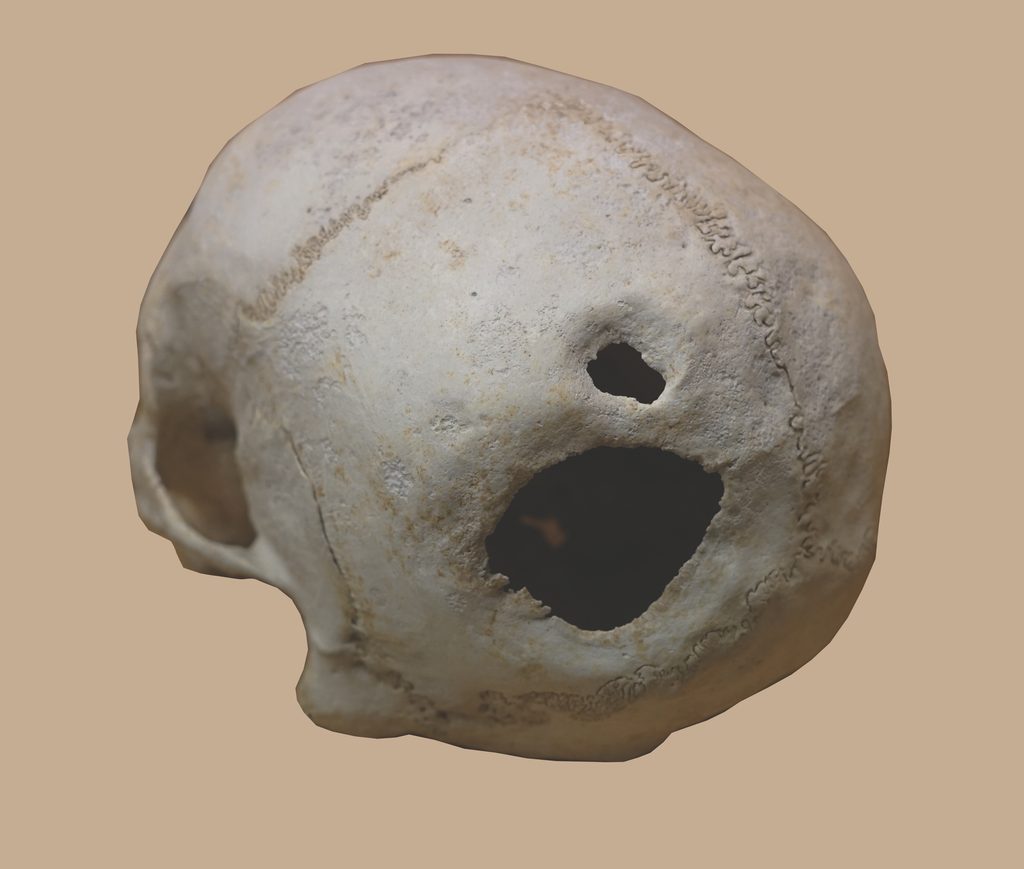 Crâne avec deux trépanations ayant cicatrisé, Musée d’Archéologie Nationale.