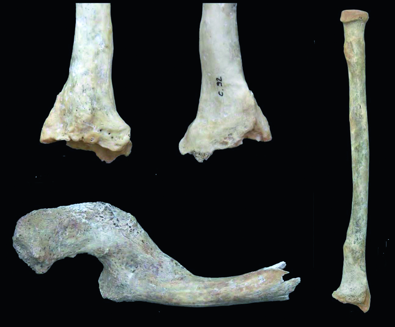 Fractures osseuses subies par les occupants de l’hypogée I du Mont Saint-Aimé à Bergères-lès-Vertus (Marne)